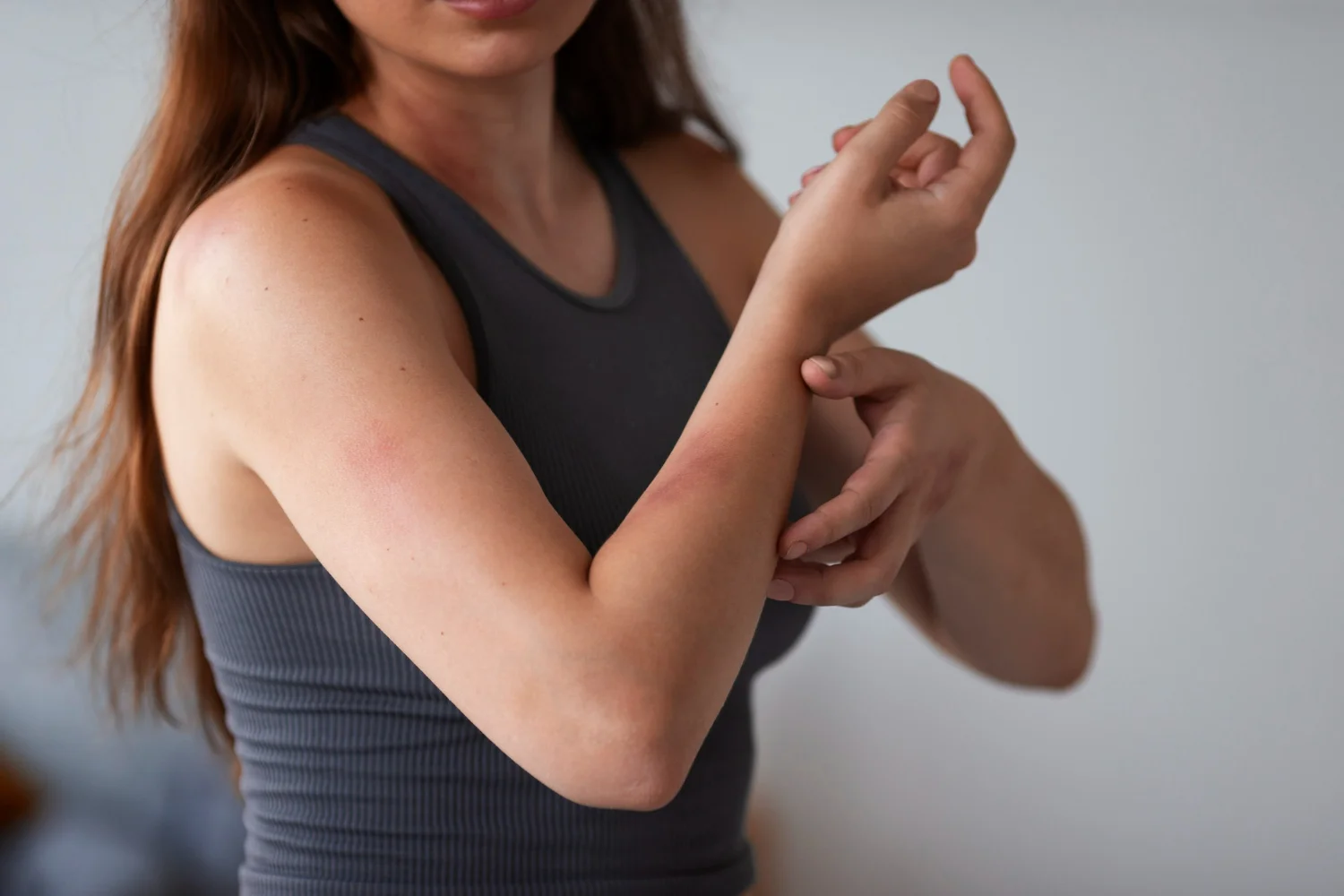 Mulher branca com dor no braço representando a tromboflebite no braço
